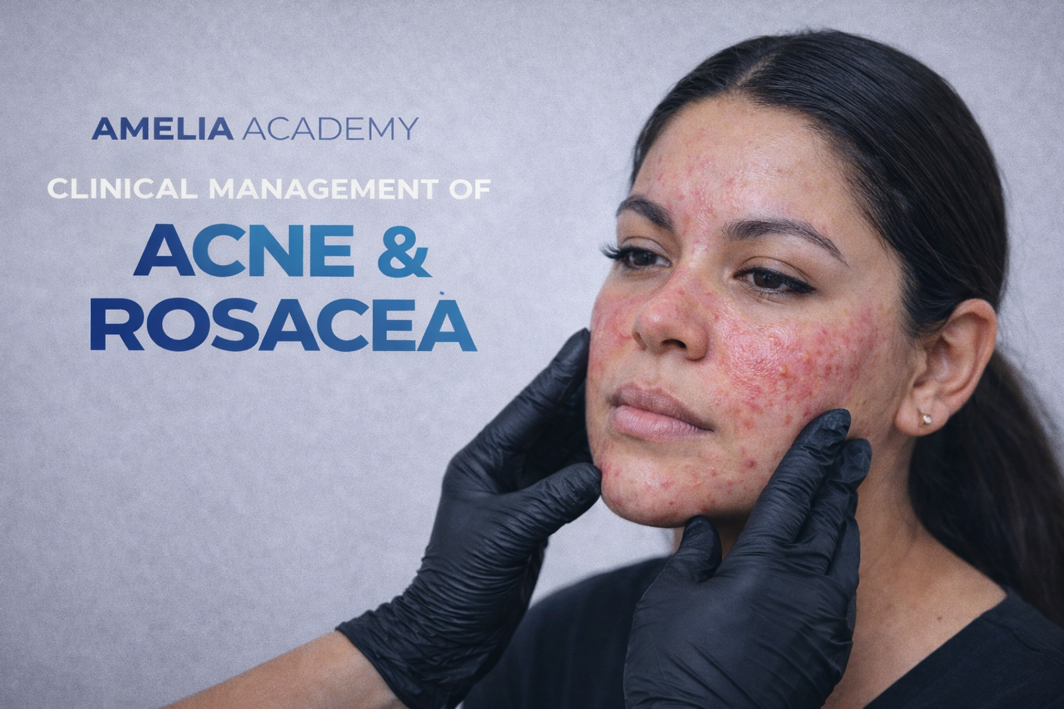 ACNE & Rosicea - Manejo Clínico Dermoestético Avanzado